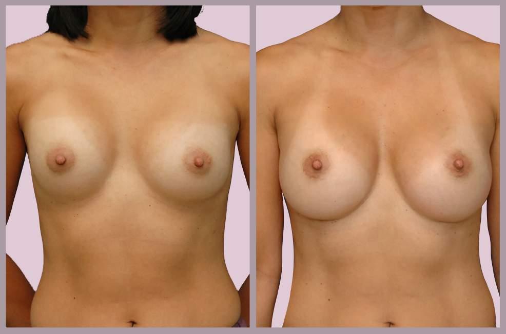 Secondary Breast Augmentation: Desire for Larger Breasts Exchange of implants (230cc