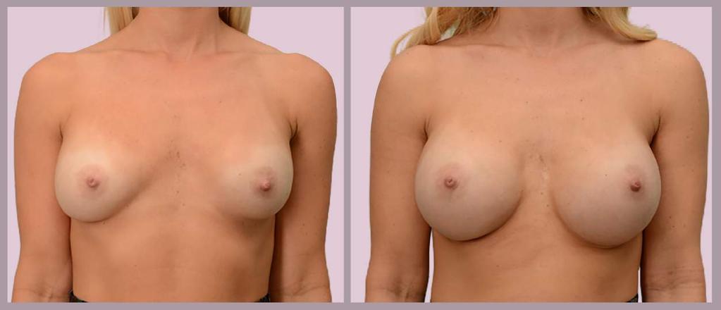 Secondary Breast Augmentation: Desire for Larger Breasts Exchange of implants (275cc