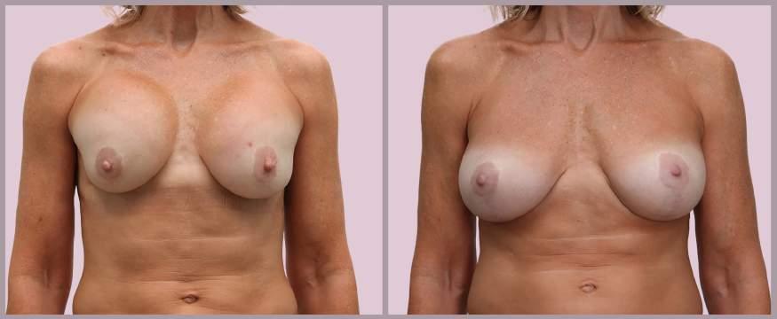 Secondary Breast Augmentation: Capsular