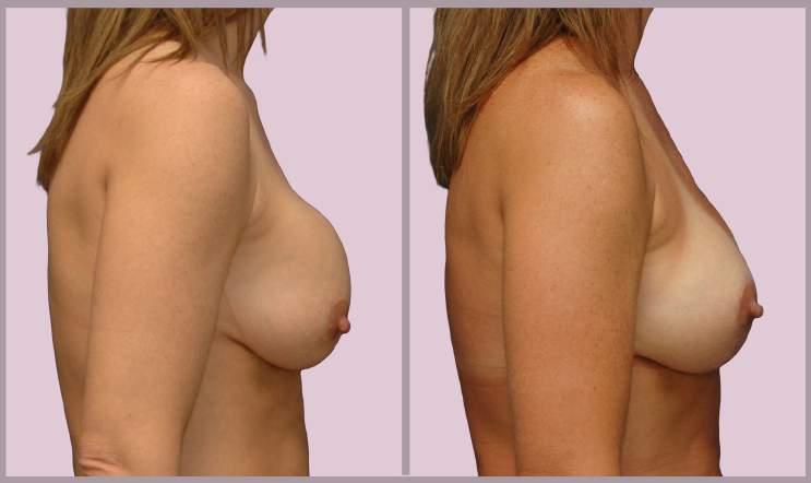 Correcting Breast Deformity and Capsular