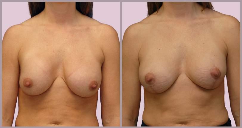 implants (375cc sub-muscular) with Vertical