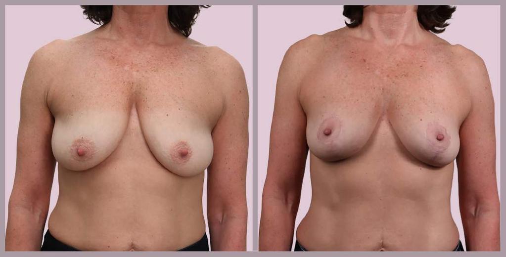 Breast Lift (with Auto-Augmentation) Breast Lift with