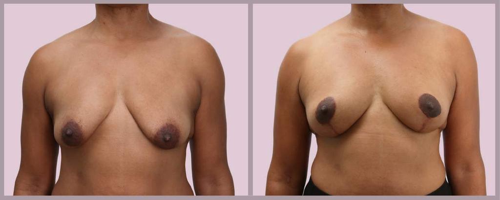 Breast Lift with Fat Grafting Breast Lift with Micro-Fat Grafting: 55
