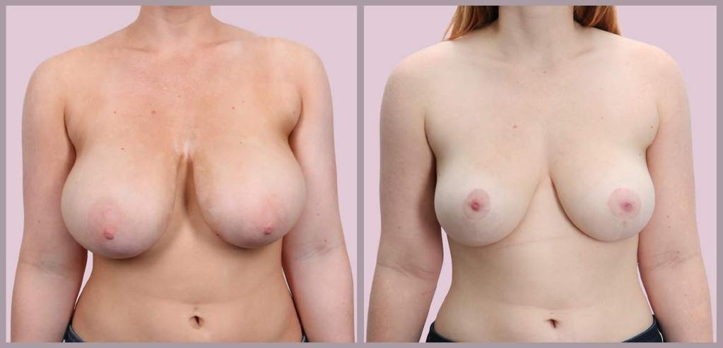 Breast Reduction (No Children) Breast Reduction with Minimal Scar ("Lollipop")