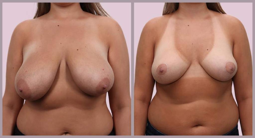 Breast Reduction (No Children) Breast Reduction and Lift with Minimal