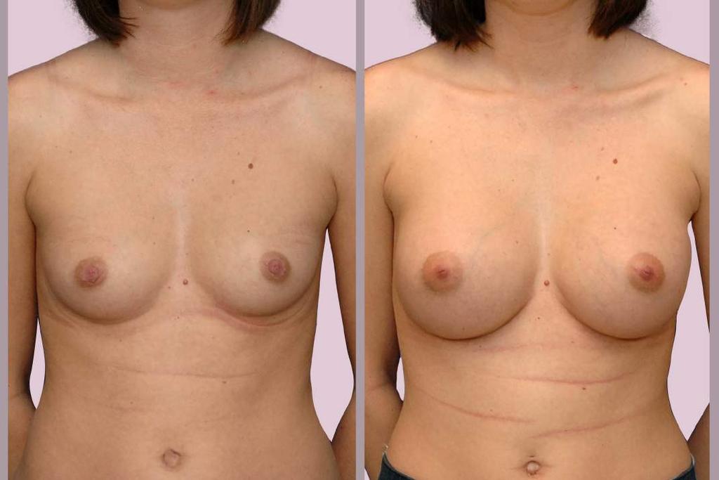Breast Augmentation: Small Breasts Breast Augmentation with Silicone