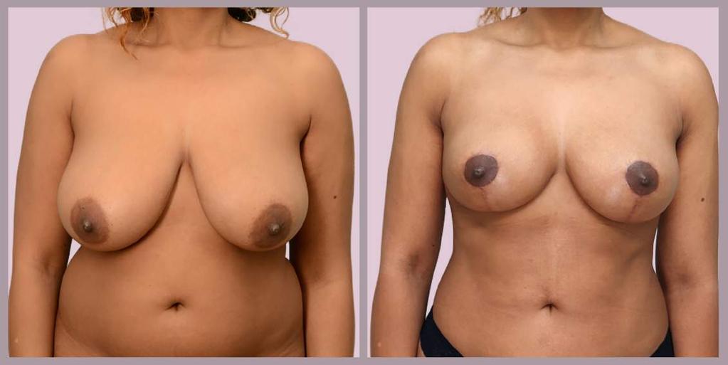 Small Breast Reduction Breast Lift with Small Reduction 42 years