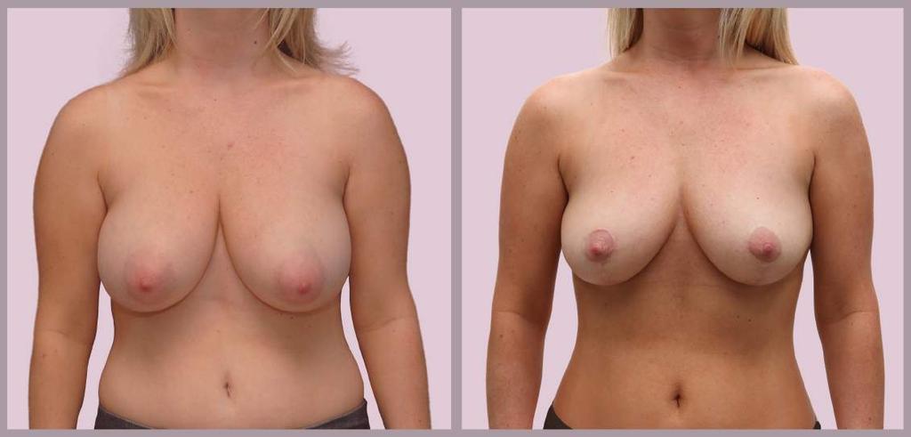 Small Breast Reduction Breast Reduction and Lift with Minimial