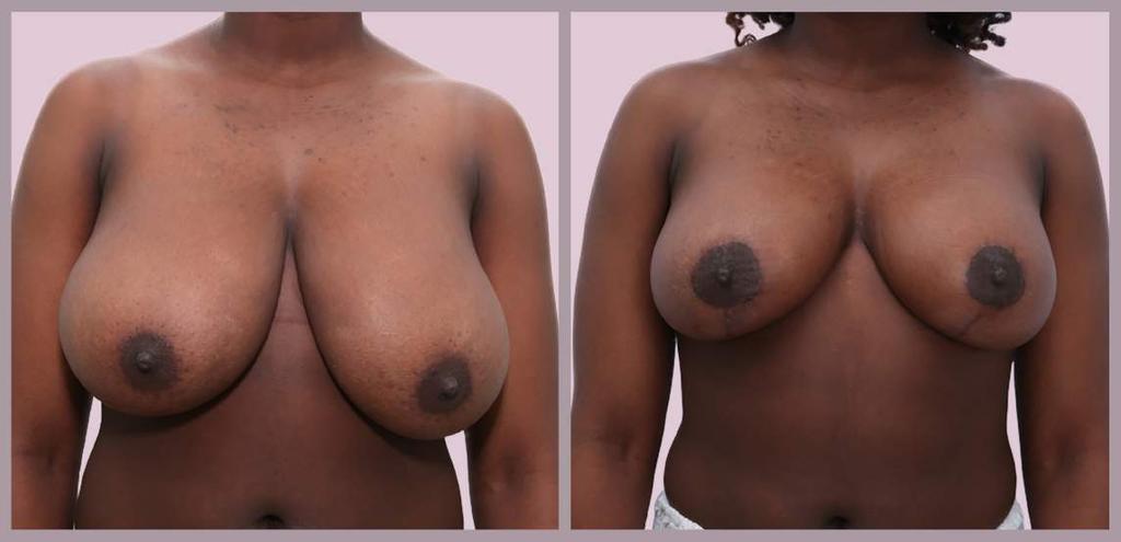 Breast Reduction Breast Reduction and Lift with Minimal Scar Technique: 2.