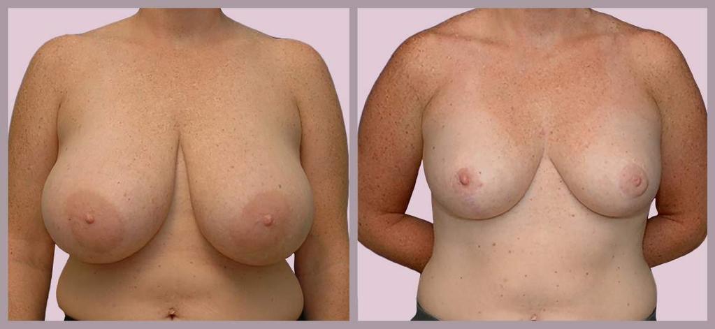 Breast Reduction: Very Large Reduction Breast Reduction with Minimal Scar ("Lollipop")