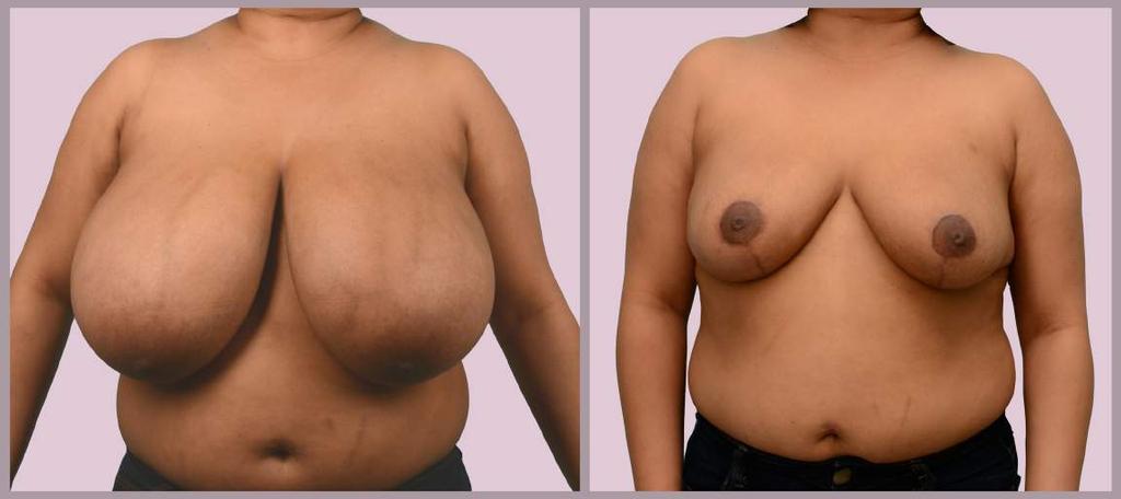 Breast Reduction: Very Large Reduction Breast Reduction with Vertical ("Lollipop") Technique: 6.7 lbs.