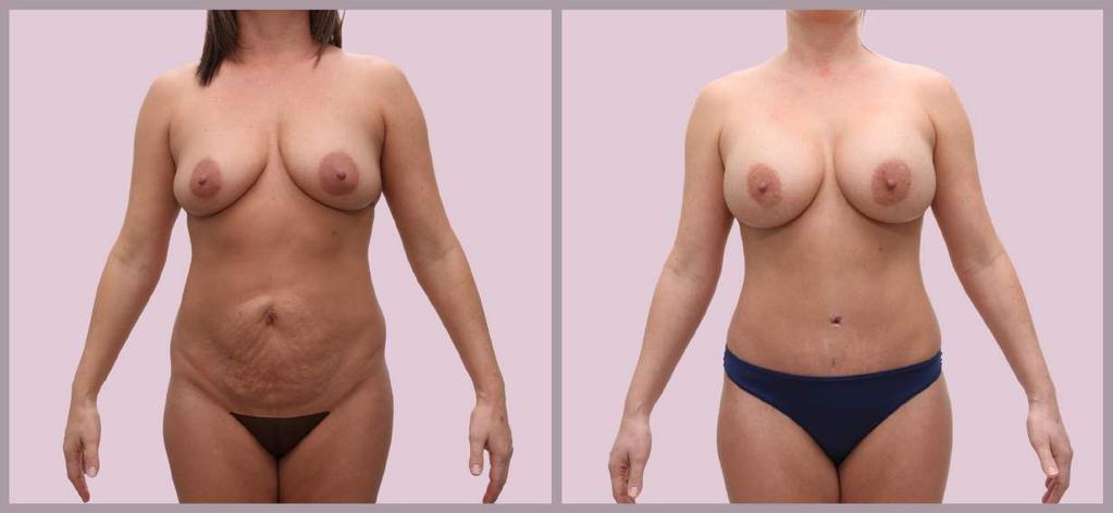 Breast + Body Breast Augmentation with Silicone implants (400cc
