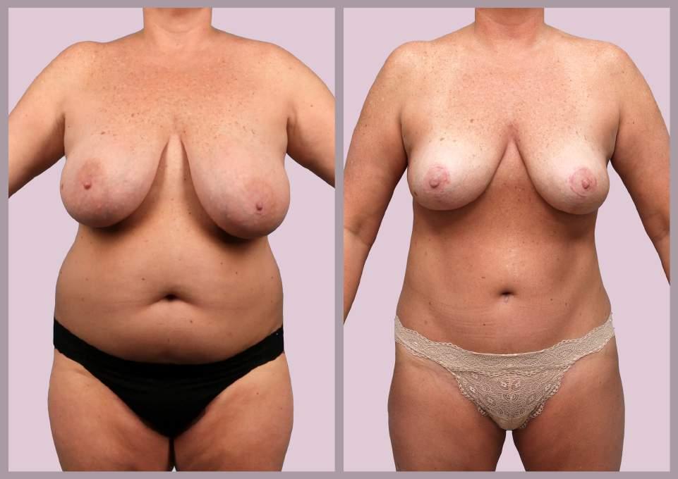 Breast + Body Extended Tummy Tuck with Liposuction and Breast