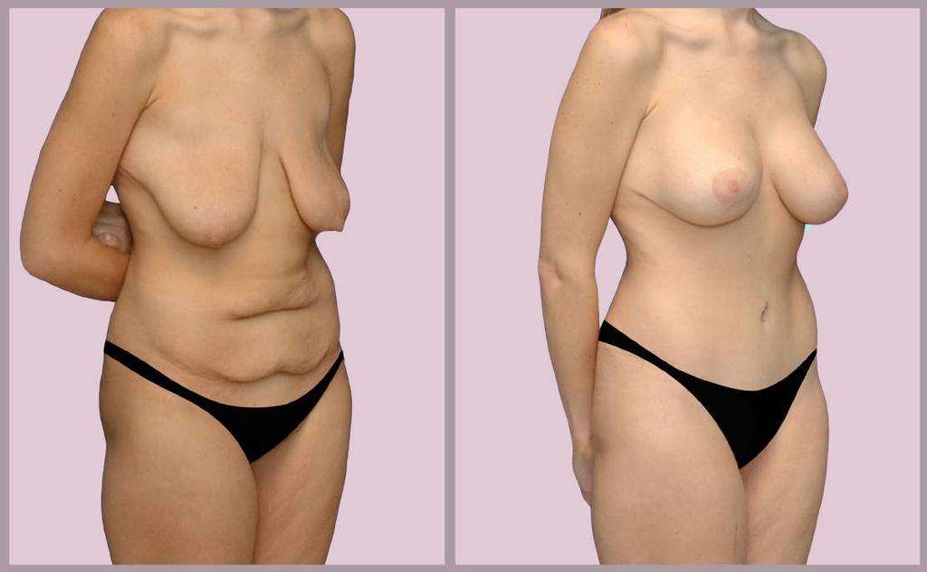 Breast + Body Surgery After Large Weight Loss Breast Augmentation with Saline implants and