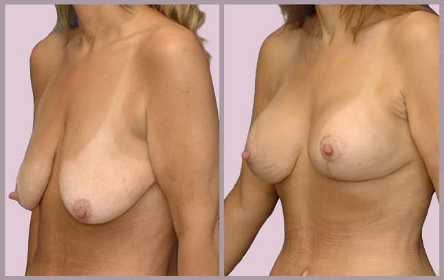 Breast Surgery After Large Weight Loss Breast