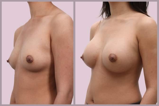 Breast Augmentation with Silicone implants (286cc
