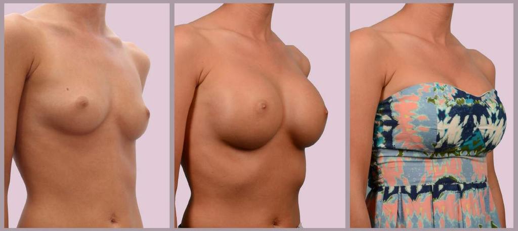 Breast Augmentation: Small Breasts, No Pregnancy Breast Augmentation with Silicone