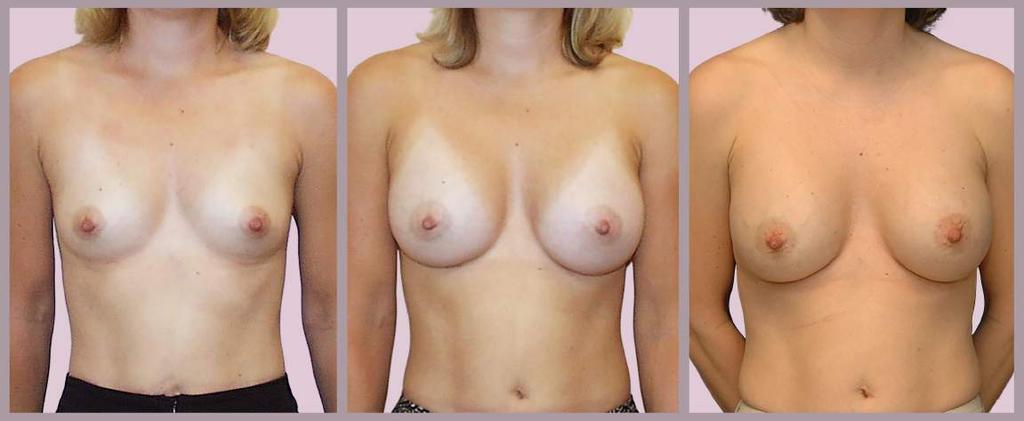 Pregnancy After Breast Augmentation before 3 month result 6 year result, post-pregnancy