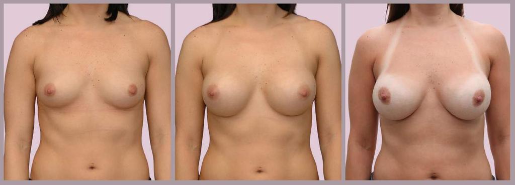 Pregnancy After Breast Augmentation before 8 month result 4 year result, post-pregnancy Breast