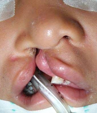 Figure 1 INITIAL DEFORMITY Pre-operative picture just before surgery. GOALS OF THE UNILATERAL CELFT LIP REPAIR Create a symmetrical lip and nose. Restore cleft lip length.