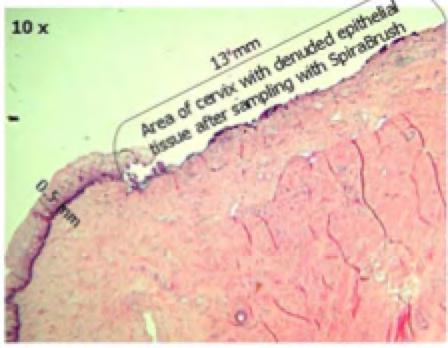 Physician / Clinician Primer Q-9: Is there evidence that the biopsy taken with SpiraBrush CX is of a trans-epithelial thickness?