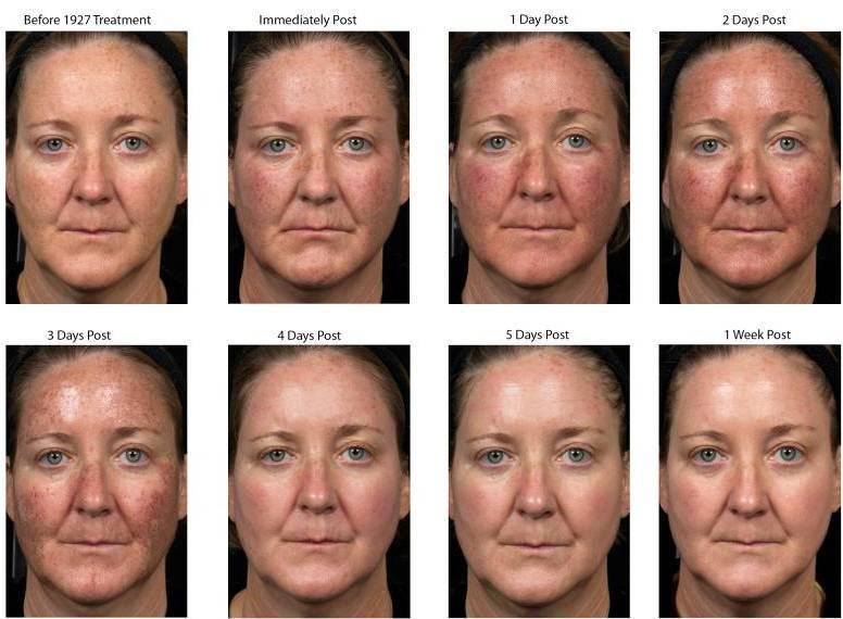 Skin Reaction Progression 1927 nm - Post 1 Treatment 10 mj TL 7 50% Coverage 8 passes All