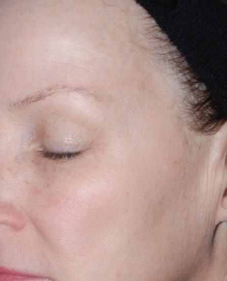 Wrinkle & Pigment Treatment Courtesy of