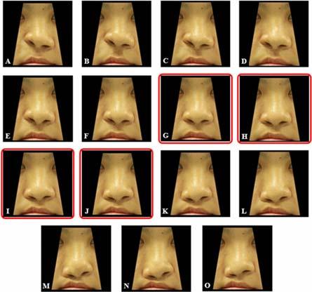 Discussion Previous studies have attempted to develop reliable methods to assess facial esthetics in repaired CLP patients. Asher-McDade et al.