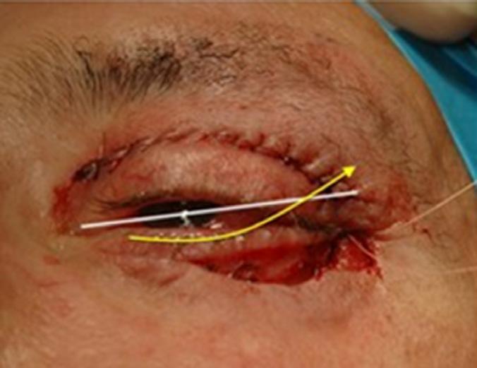A third orbicularis suspension suture is placed which opposes the superior and inferior incised margins of the orbicularis muscle and secures the complex to the periosteum of the lateral orbital