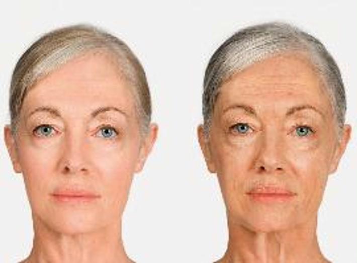 Fotolia XIII - Fotolia Alice, 60 years of age reaction to sunshine: left = moderate sunshine with adequate UV protection right = strong sunshine without adequate UV protection Picture: