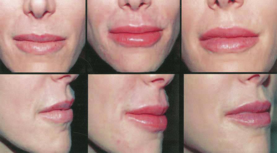 A B C D E F Figure. A, D, Pretreatment view of a 47-year-old woman. B, E, Posttreatment view immediately after injection of 0.7 ml of Restylane into the nasolabial folds and 0.