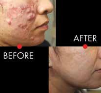 LightPod Neo Aerolase 650 ms laser technology offers a new approach for highly effective, long lasting results for treating active acne including problematic conditions such as nodulocystic acne and