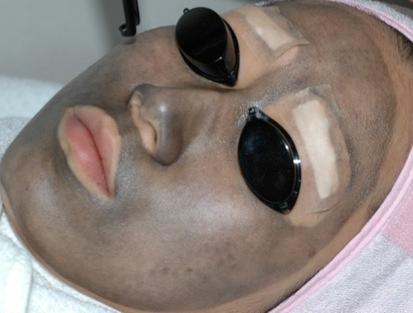 aper the 3rd Treatment Sopens Skin Tone Improves Skin Texture ConNnues to Regenerate Collagen Reduces Inflamed Acne and
