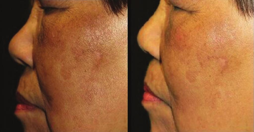 Patients reported improvement in both pigmentation and skin quality with minimal downtime. Dr.