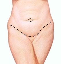 Tummy Tuck If you want a tighter, flatter abdomen, then a tummy tuck may be appropriate to help achieve your