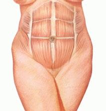 Also known as abdominoplasty, a tummy tuck removes excess fat and skin, and in some cases restores weakened