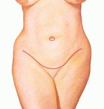 Procedural steps: A tummy tuck involves the surgical removal of excess abdominal fat and skin and includes