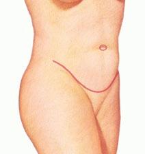 When a correction is isolated to the area below the navel, a limited or mini tummy tuck with a shorter