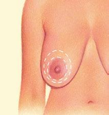 Breast Lift A breast lift raises and firms the breasts by removing excess skin and tightening the surrounding tissue to
