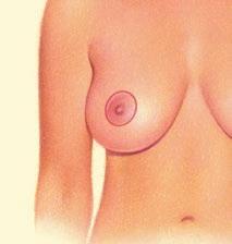 Sometimes the areola becomes enlarged over time, and a breast lift will reduce this as well.