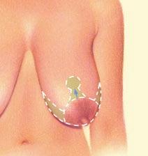 firmness. The nipple and areola are repositioned to a natural, more youthful height.