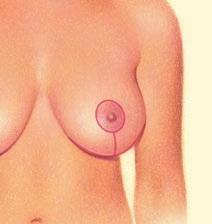 Excess breast skin is removed to compensate for a loss of elasticity.