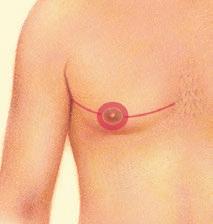 Excision also is necessary if the areola will be reduced or the nipple will be repositioned to a more natural male contour.