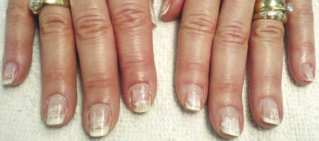 White spots on nails after a gel-polish removal are the tell-tale sign that the gel-polish was removed with too much force and that