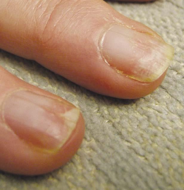HELPFUL HINTS With the biggest problem being inadequate soak-off times and nail damage during subsequent forced gel removal, there are