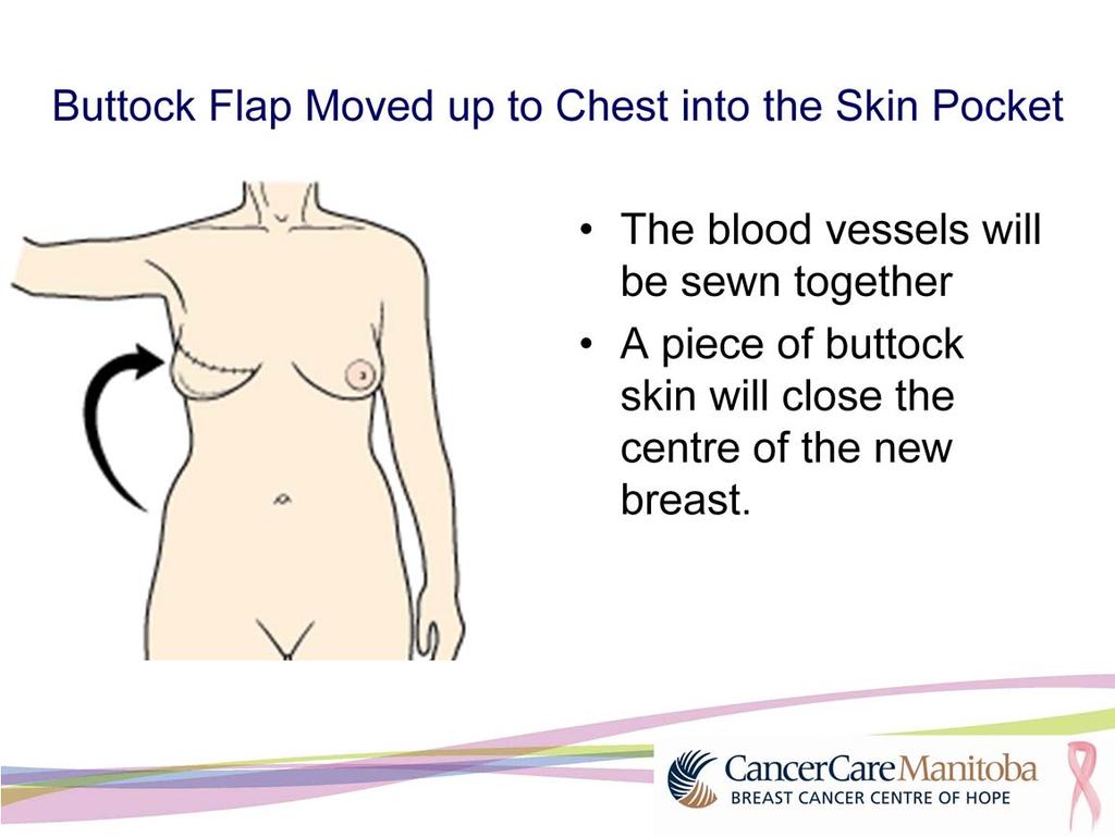The buttock flap will be moved up to the chest, and into the breast skin pocket, the same way as the tummy