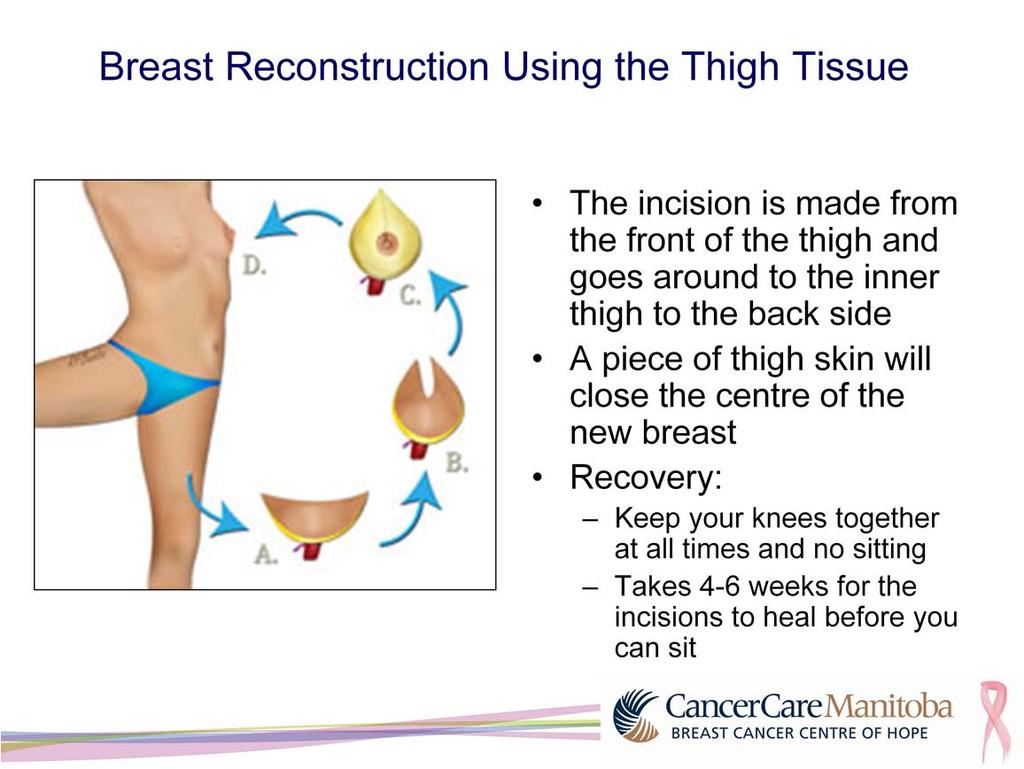 This picture shows the steps when TUG surgery is used. The incision is made from the front of the thigh and goes around the inner thigh to the back side.