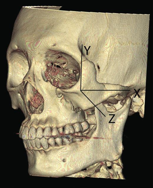 Baek JE et al. Reduction of zygomatic fractures using the Carroll-Girard T-bar screw Fig. 2. Case 1 (A) Exposure of the inferior orbital rim through a subciliary incision.