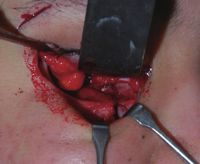 (B) Fixation of the inferior orbital rim using a curved 6-hole absorbable plate and biodegradable screws.