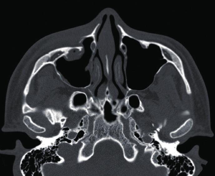 (C) Preoperative axial view of computed tomographic (CT) scans showing a displaced zygomatic complex.